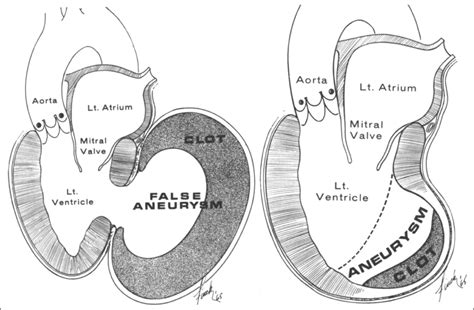 lv pseudoaneurysm|ventricular aneurysm vs pseudoaneurysm.